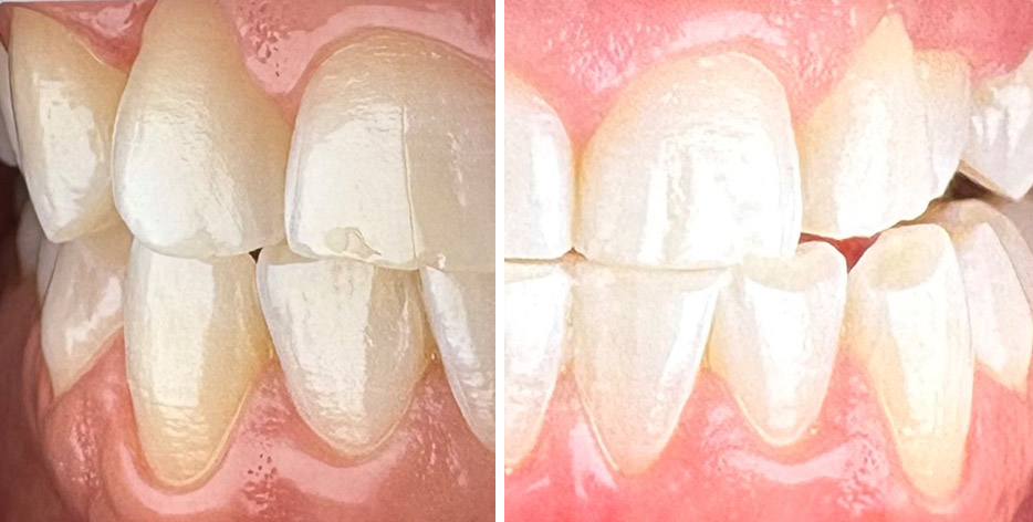 Jan before after