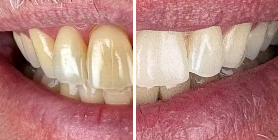 Before and After Teeth Whitening